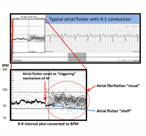 ECG plot of an atrial flutter with an atrial fibrillation "cloud"